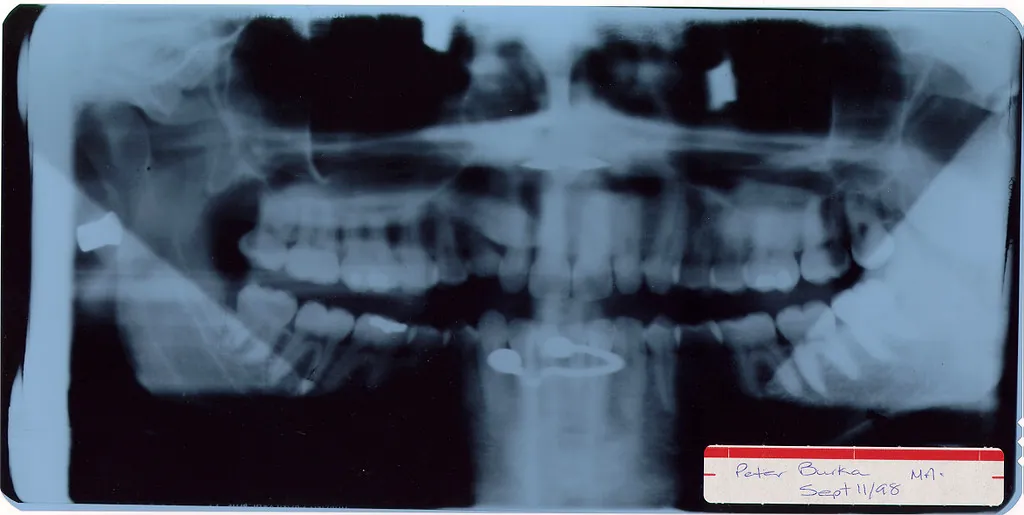 Endodoncia