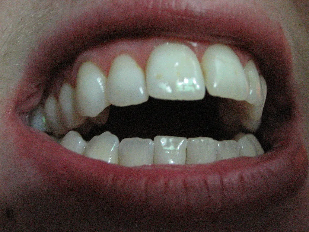 Implantes dentales